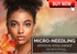 EXION RF MICRONEEDLING AI TREATMENT