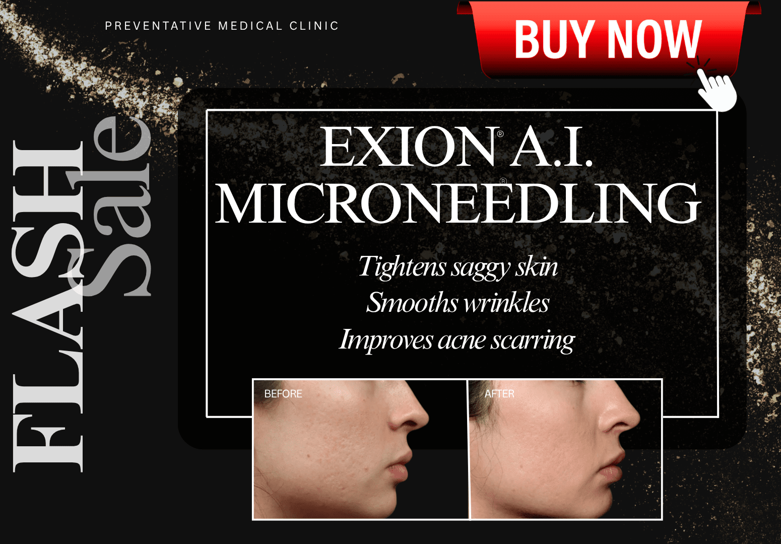 FLASH SALE : EXION RF MICRONEEDLING : FACE & NECK