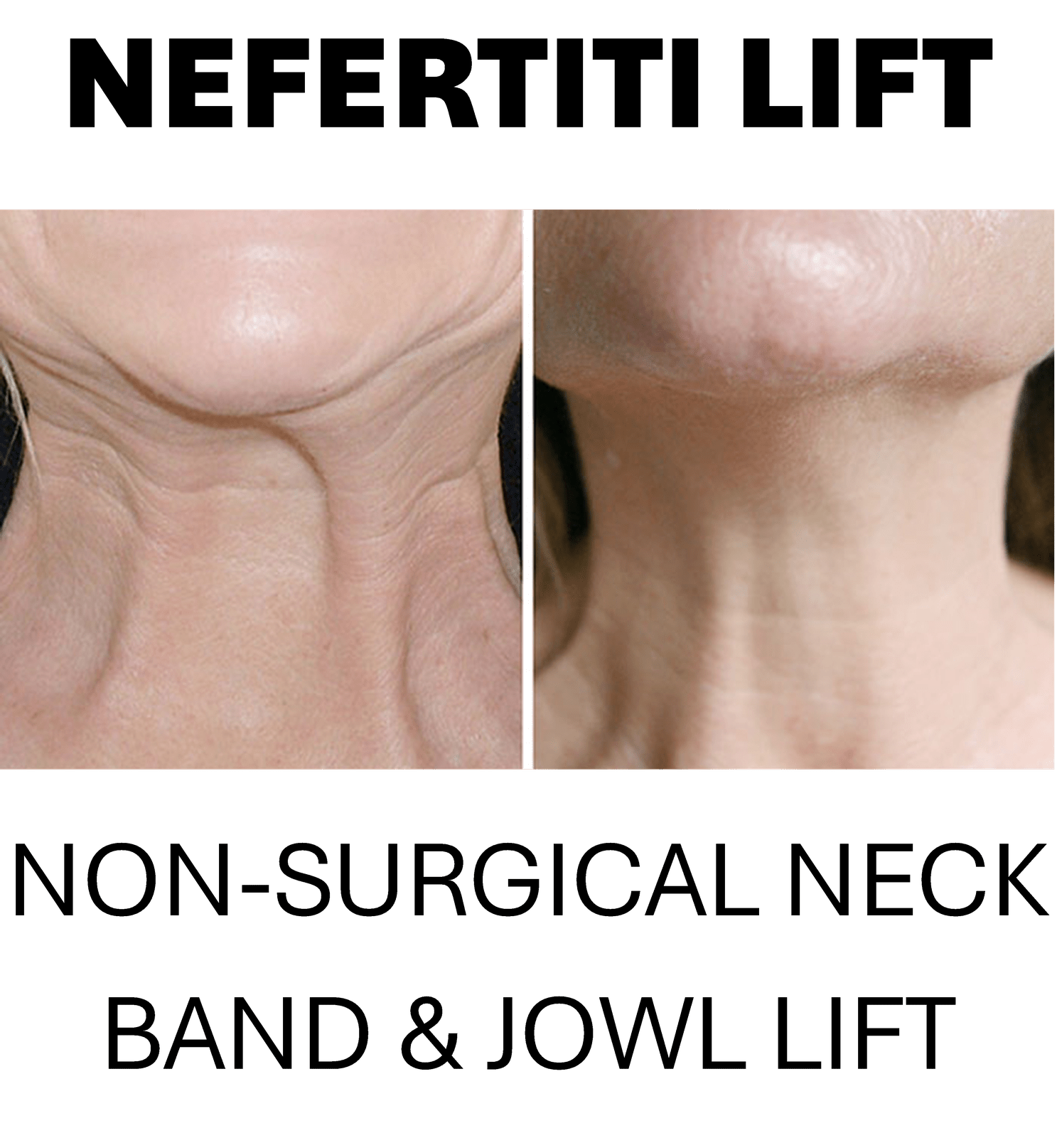 NERFERTITI LIFT - NON SURGICAL NECK BAND & JOWL LIFT